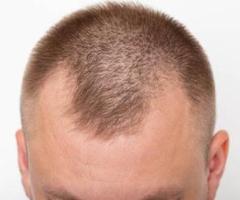 SMP by ROB | Hair Replacement Service in San Dimas CA