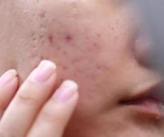 Acne & Acne Scar Treatment - HASH CLINICS